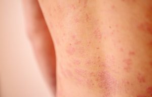 Silicone allergy
